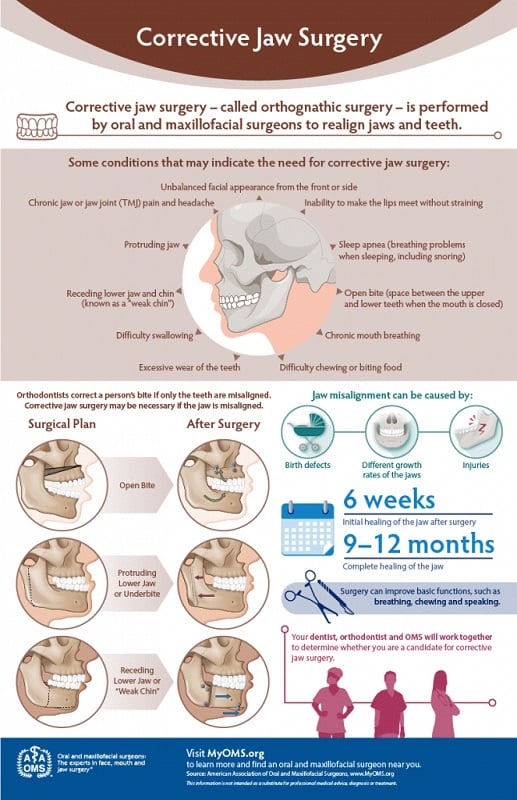 Chart for description of what to expect from jaw surgery procedure